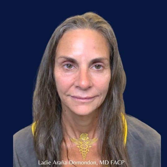 Full Face Rejuvenation — after