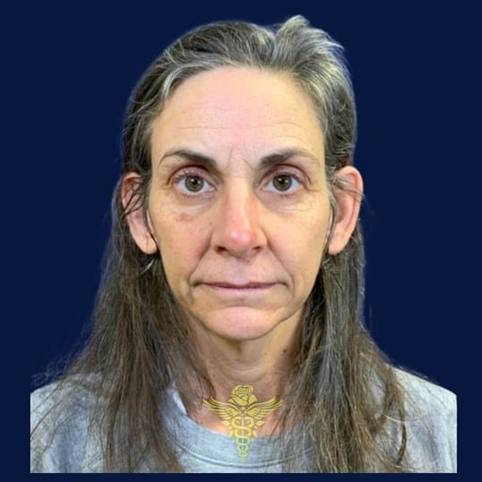 Full Face Rejuvenation — before