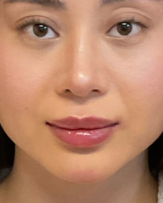 Lip Shaping — after