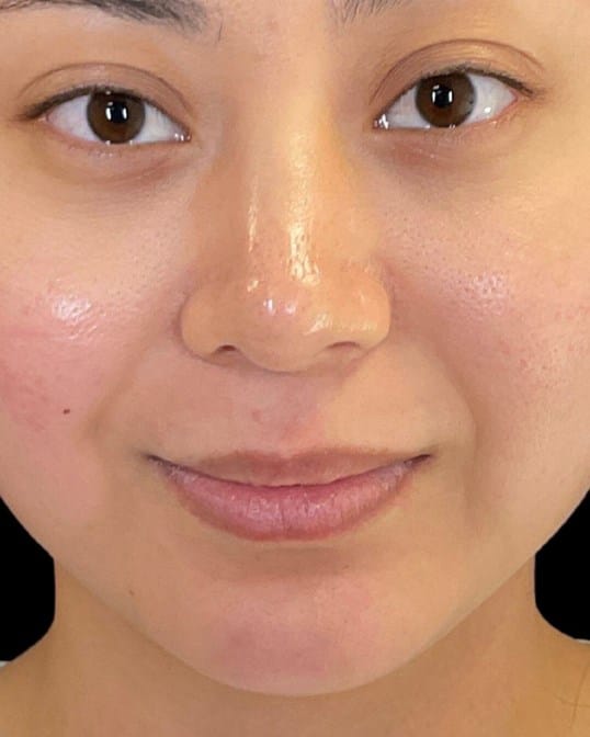Lip Shaping — before