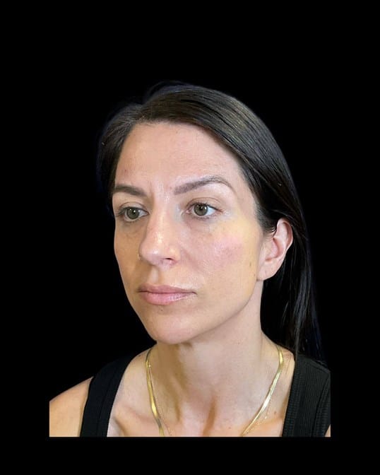 Filler Contour Lift — after