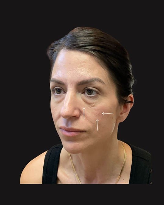 Filler Contour Lift — before