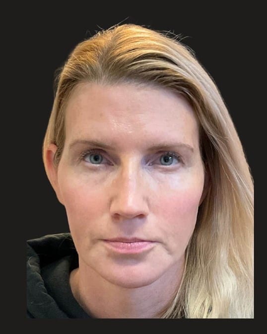 HALO&trade; Laser & IPL Photofacial — after