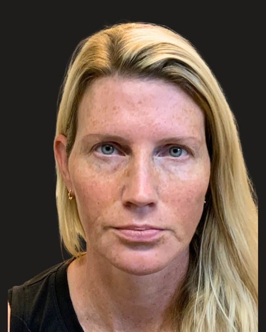 HALO&trade; Laser & IPL Photofacial — before