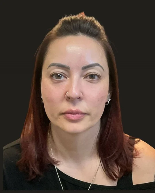 Midface Volume Restoration — after