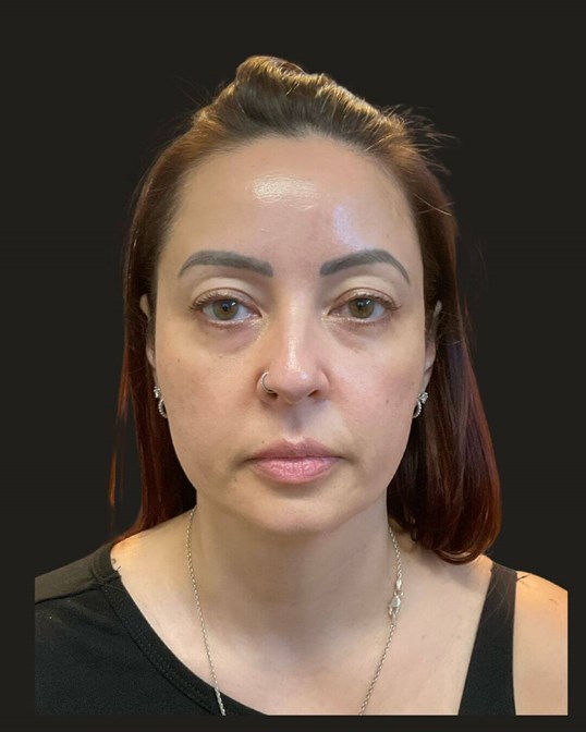 Midface Volume Restoration — before