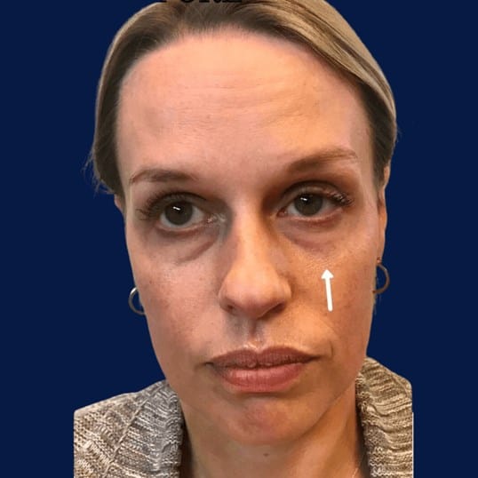 Tear Trough Correction — before